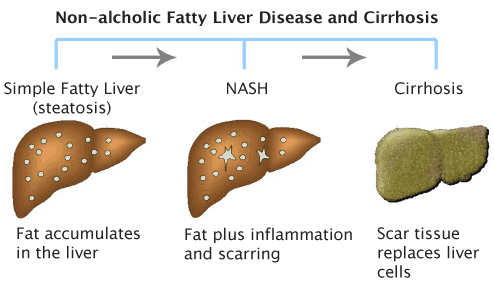 Is Liver Dmg From Fat Or Alcohol